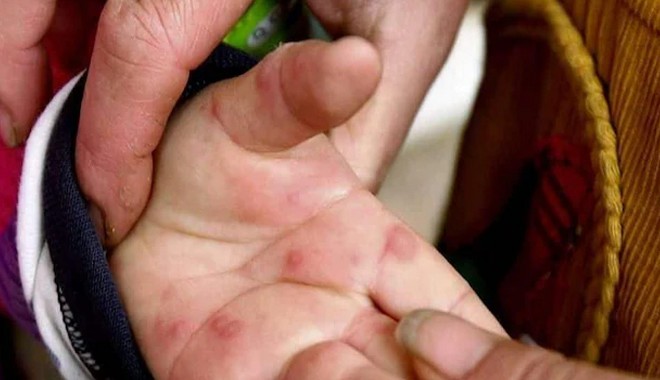 Γρίπη της τομάτας: Τι ισχύει για τη νέα μόλυνση που αφορά μικρά παιδιά
