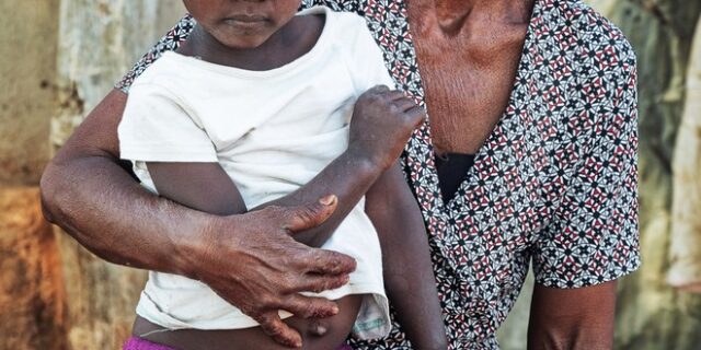 Πάνω από 100 εκατ. κορίτσια και γυναίκες έχουν υποστεί ακρωτηριασμό γεννητικών οργάνων
