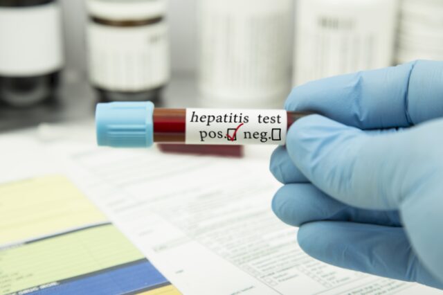 ECDC: “Καμπανάκι” για μεγάλο αριθμό κρουσμάτων ηπατίτιδας Α στην Ευρώπη