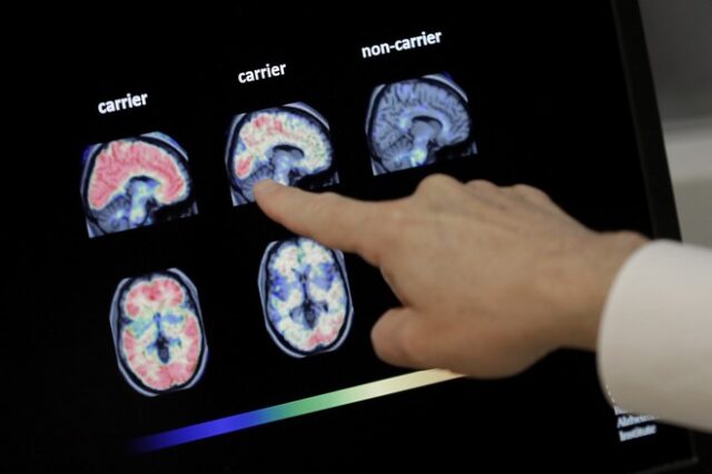 Σπουδαία ανακάλυψη για το Αλτσχάιμερ: Βρέθηκε εξέταση αίματος για τη διάγνωση της νόσου
