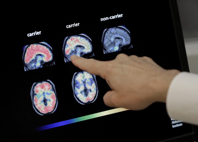 Σπουδαία ανακάλυψη για το Αλτσχάιμερ: Βρέθηκε εξέταση αίματος για τη διάγνωση της νόσου
