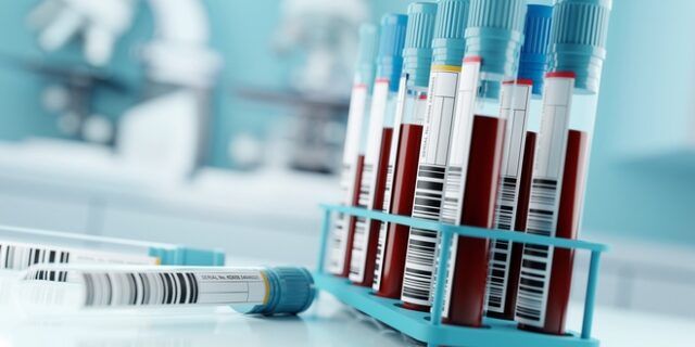 Αλτσχάιμερ: Τεστ αίματος μπορεί να ανιχνεύσει ίχνη της νόσου χρόνια πριν τα πρώτα συμπτώματα