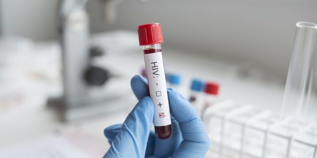 Ασθενής θεραπεύτηκε από τον ιό του AIDS μετά από μεταμόσχευση φυσιολογικών βλαστοκυττάρων