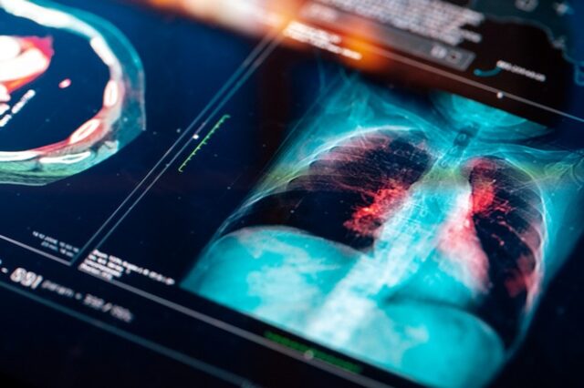 Έρευνα – “σταθμός”: Χάπι για τον καρκίνο του πνεύμονα μειώνει στο μισό τον κίνδυνο θανάτου