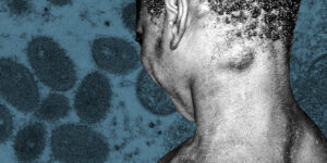 Ευλογιά των Πιθήκων: Όσα χρειάζεται να ξέρετε