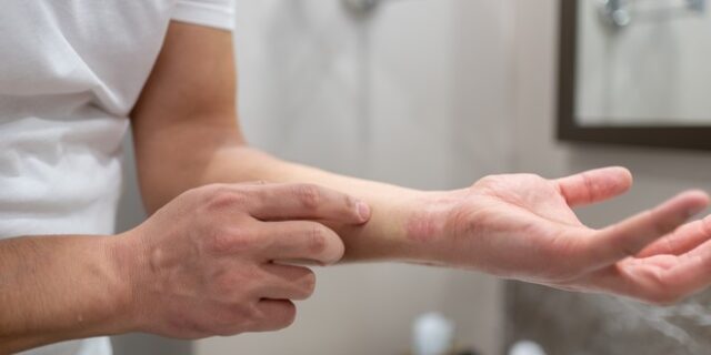 Σοκαριστική καταγγελία: Έδιωξαν οροθετικό άτομο από εξοχικό, φοβούμενοι πως θα τους μεταδόσει HIV μέσω… κουνουπιών