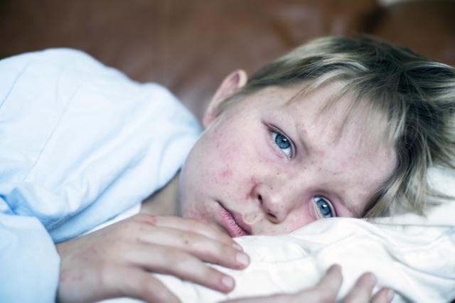 Παιδί με τα χαρακτηριστικά εξανθήματα της ιλαράς