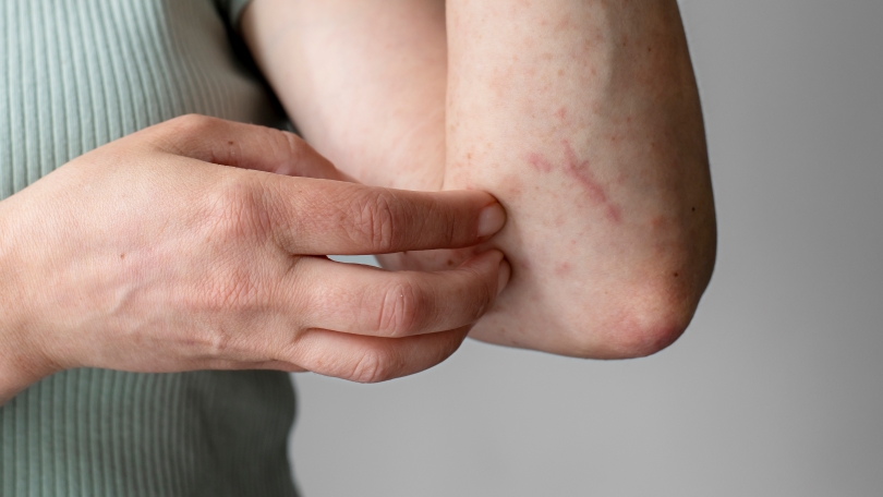 skin allergy reaction test arm