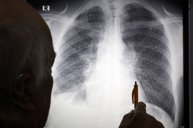 Πώς να καταλάβεις ότι κάτι δεν πάει καλά με τους πνεύμονές σου