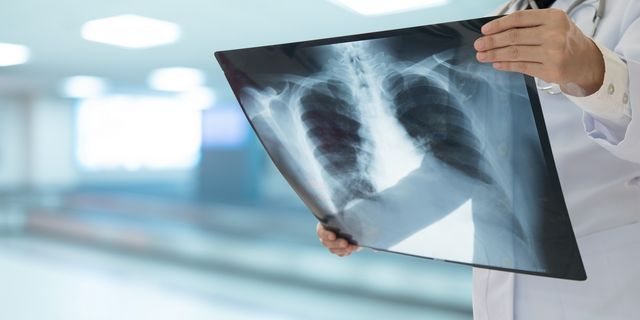 Φυματίωση: Συναγερμός στην Ευρώπη για την αύξηση των κρουσμάτων σε παιδιά – Τι ισχύει στην Ελλάδα