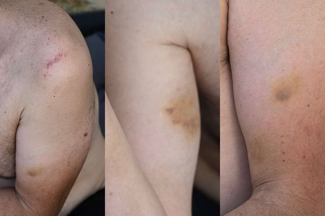 Οι κακώσεις από τη βία των αστυνομικών στη Μύκονο