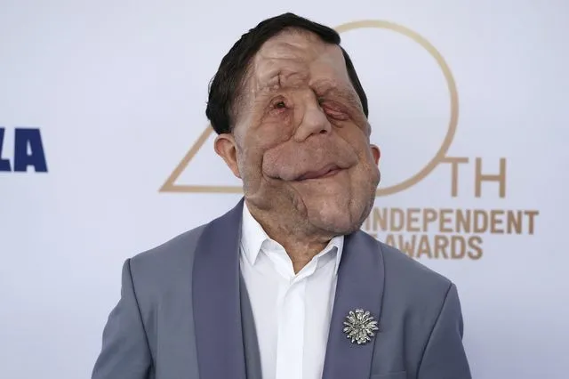 Το “The Elephant Man” ξανά στην μεγάλη οθόνη με πρωταγωνιστή τον Άνταμ Πίρσον