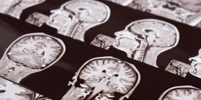 Πώς οι νευροεπιστήμες εξηγούν την ψυχολογία του φανατισμού