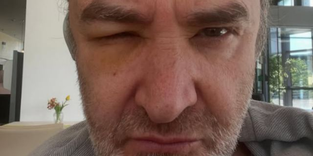 Νίκος Ορφανός: Η φωτογραφία με χτυπημένο μέτωπο και μάτι – “Βγαίνω νικητής”