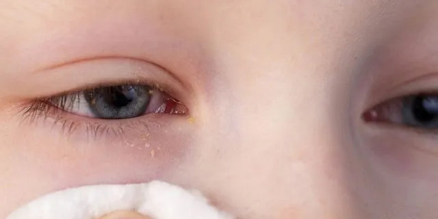 Tι έχεις όταν οι τσίμπλες σου γίνονται λευκές, κίτρινες ή πράσινες