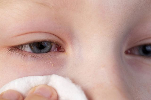 Tι έχεις όταν οι τσίμπλες σου γίνονται λευκές, κίτρινες ή πράσινες