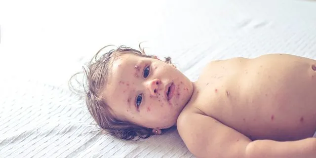 Παιδί με ιλαρά