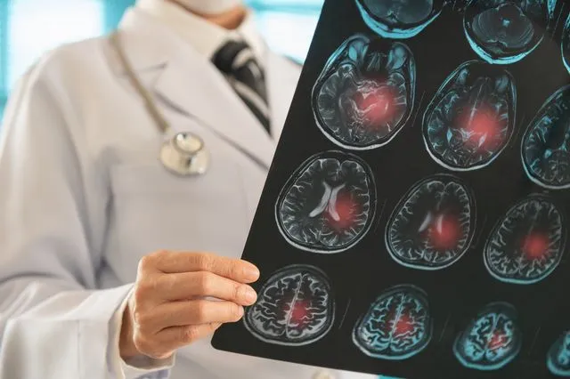 Το σπάνιο σύμπτωμα του εγκεφαλικού