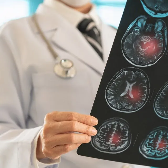 Το σπάνιο σύμπτωμα του εγκεφαλικού