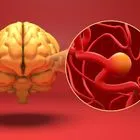 Eγκεφαλικό ανεύρυσμα είναι ένα αδύναμο ή λεπτό σημείο σε μια αρτηρία του εγκεφάλου που διογκώνεται ή προεξέχει και γεμίζει με αίμα. Το διογκωμένο ανεύρυσμα μπορεί να ασκήσει πίεση στα νεύρα ή στον εγκεφαλικό ιστό. Μπορεί επίσης να σπάσει ή να υποστεί ρήξη, με αποτέλεσμα να χυθεί αίμα στον περιβάλλοντα ιστό (φαινόμενο που ονομάζεται αιμορραγία).