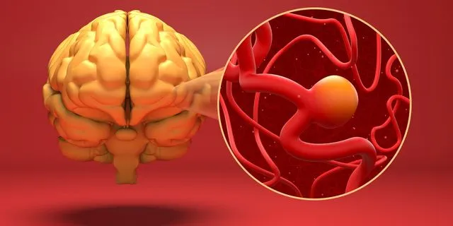 Eγκεφαλικό ανεύρυσμα είναι ένα αδύναμο ή λεπτό σημείο σε μια αρτηρία του εγκεφάλου που διογκώνεται ή προεξέχει και γεμίζει με αίμα. Το διογκωμένο ανεύρυσμα μπορεί να ασκήσει πίεση στα νεύρα ή στον εγκεφαλικό ιστό. Μπορεί επίσης να σπάσει ή να υποστεί ρήξη, με αποτέλεσμα να χυθεί αίμα στον περιβάλλοντα ιστό (φαινόμενο που ονομάζεται αιμορραγία).