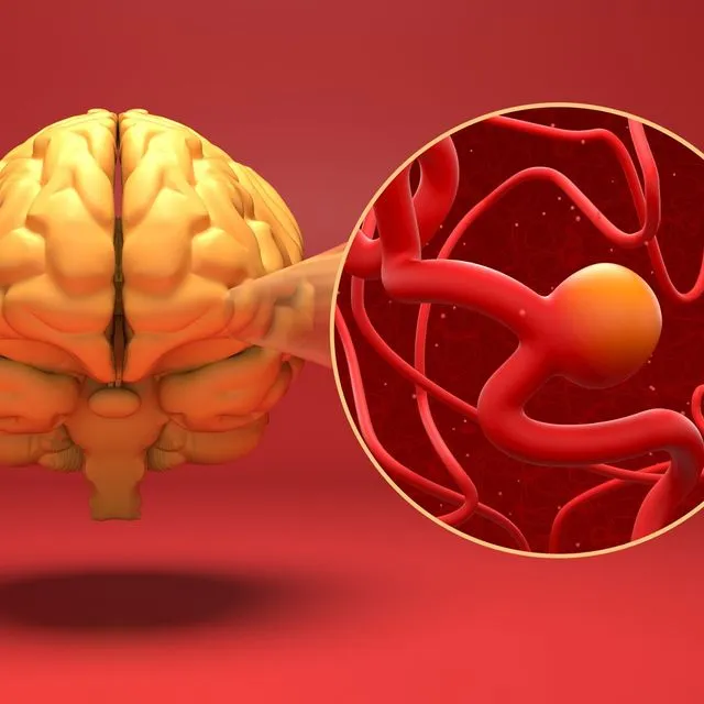 Eγκεφαλικό ανεύρυσμα είναι ένα αδύναμο ή λεπτό σημείο σε μια αρτηρία του εγκεφάλου που διογκώνεται ή προεξέχει και γεμίζει με αίμα. Το διογκωμένο ανεύρυσμα μπορεί να ασκήσει πίεση στα νεύρα ή στον εγκεφαλικό ιστό. Μπορεί επίσης να σπάσει ή να υποστεί ρήξη, με αποτέλεσμα να χυθεί αίμα στον περιβάλλοντα ιστό (φαινόμενο που ονομάζεται αιμορραγία).