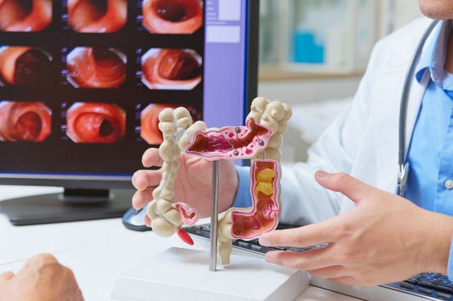 Γιατρός χρησιμοποιεί ένα μοντέλο του παχέος εντέρου για να εξηγήσει τη διάγνωση του καρκίνου του εντέρου.