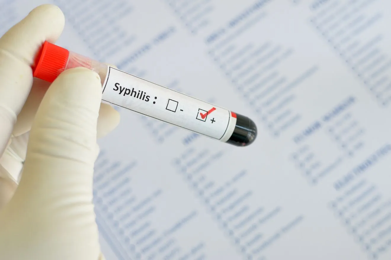 Syphilis positive
