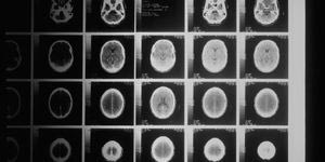 Whole Body MRI (Ολόσωμη Μαγνητική Τομογραφία): Σύγχρονη απεικόνιση για την έγκαιρη ανίχνευση σημαντικών ευρημάτων