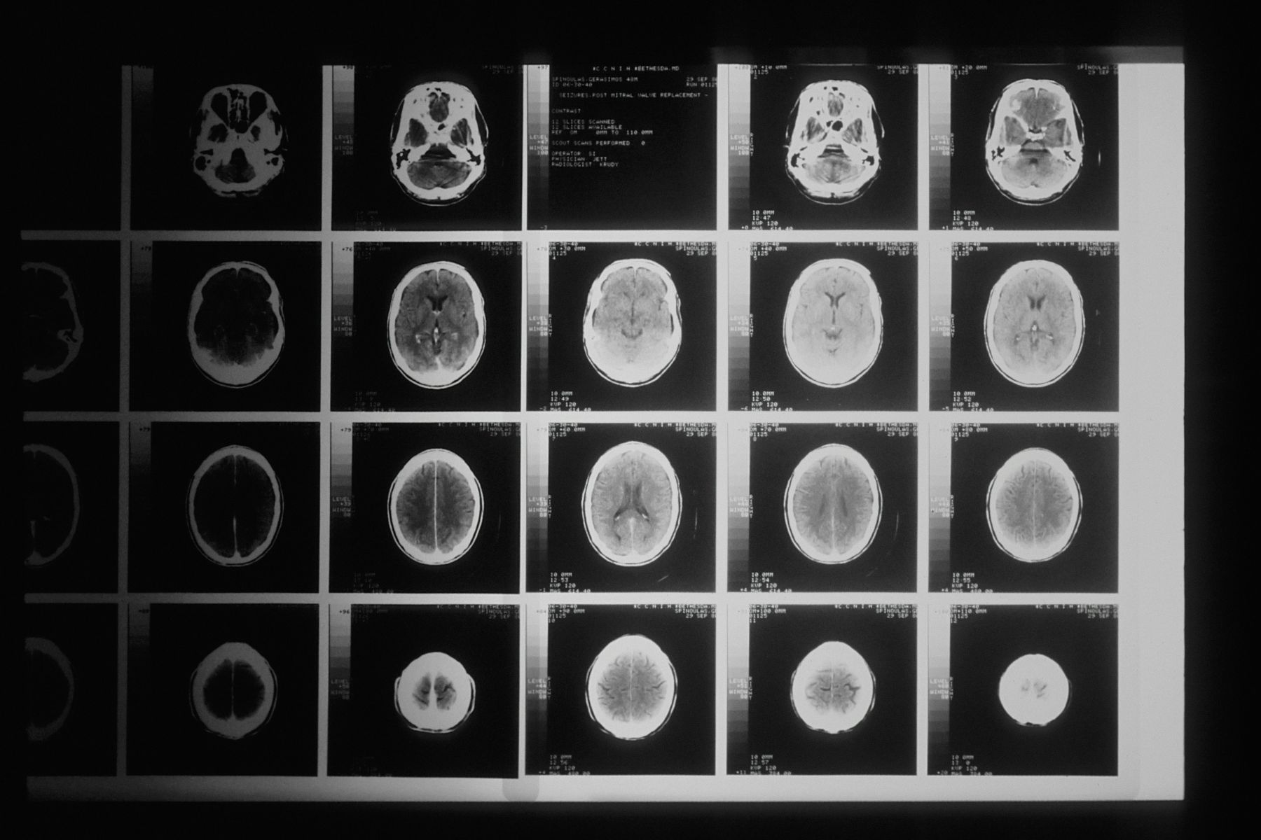 Whole Body MRI (Ολόσωμη Μαγνητική Τομογραφία): Σύγχρονη απεικόνιση για την έγκαιρη ανίχνευση σημαντικών ευρημάτων