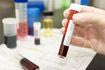 Φίτζι: Σε κατάσταση εθνικής κρίσης λόγω HIV – Ένας στους 60 έχεις AIDS